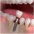 single-tooth-implant