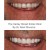 Replacement Veneers 2