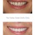 Replacement Veneers 3