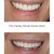 Replacement Veneers 4