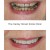 Replacement Veneers 5